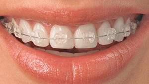 Invisalign Azusa - Invisible Braces