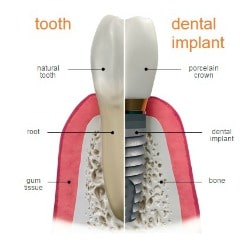 dental implant diagram