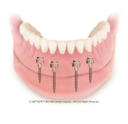 mini implant diagram