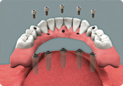 Overdenture diagram Westover Family Dentistry Winchester VA