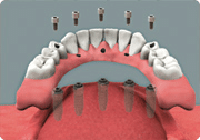 Overdenture diagram