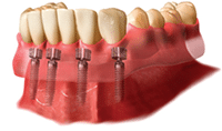 overdenture diagram 2