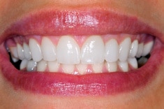 veneers