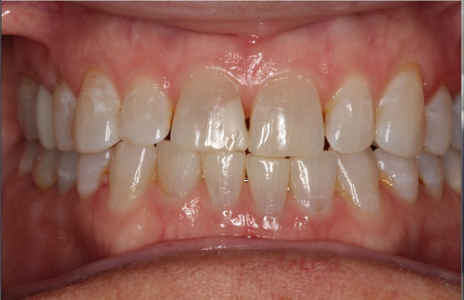 Before Dental Treatment Westover Family Dentistry in Winchester, VA