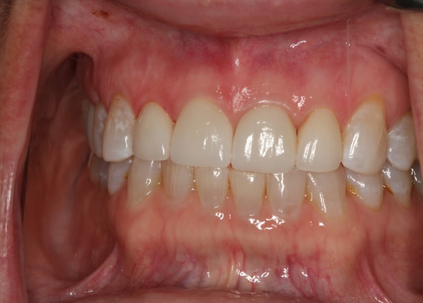 After Dental Treatment Westover Family Dentistry in Winchester, VA