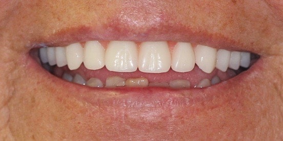 After Dental Treatment Westover Family Dentistry in Winchester, VA