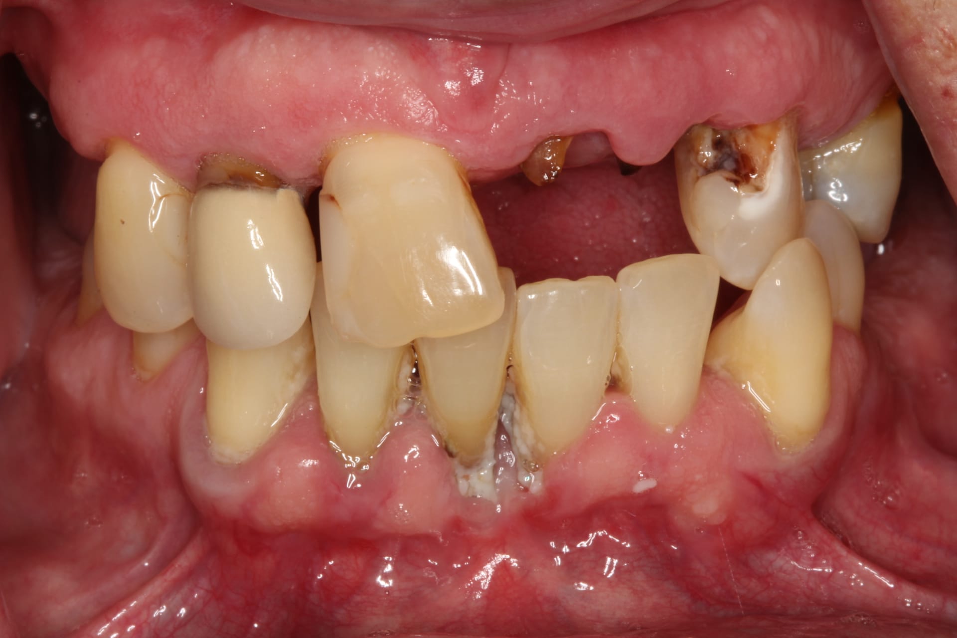 Before Dental Treatment Westover Family Dentistry in Winchester, VA