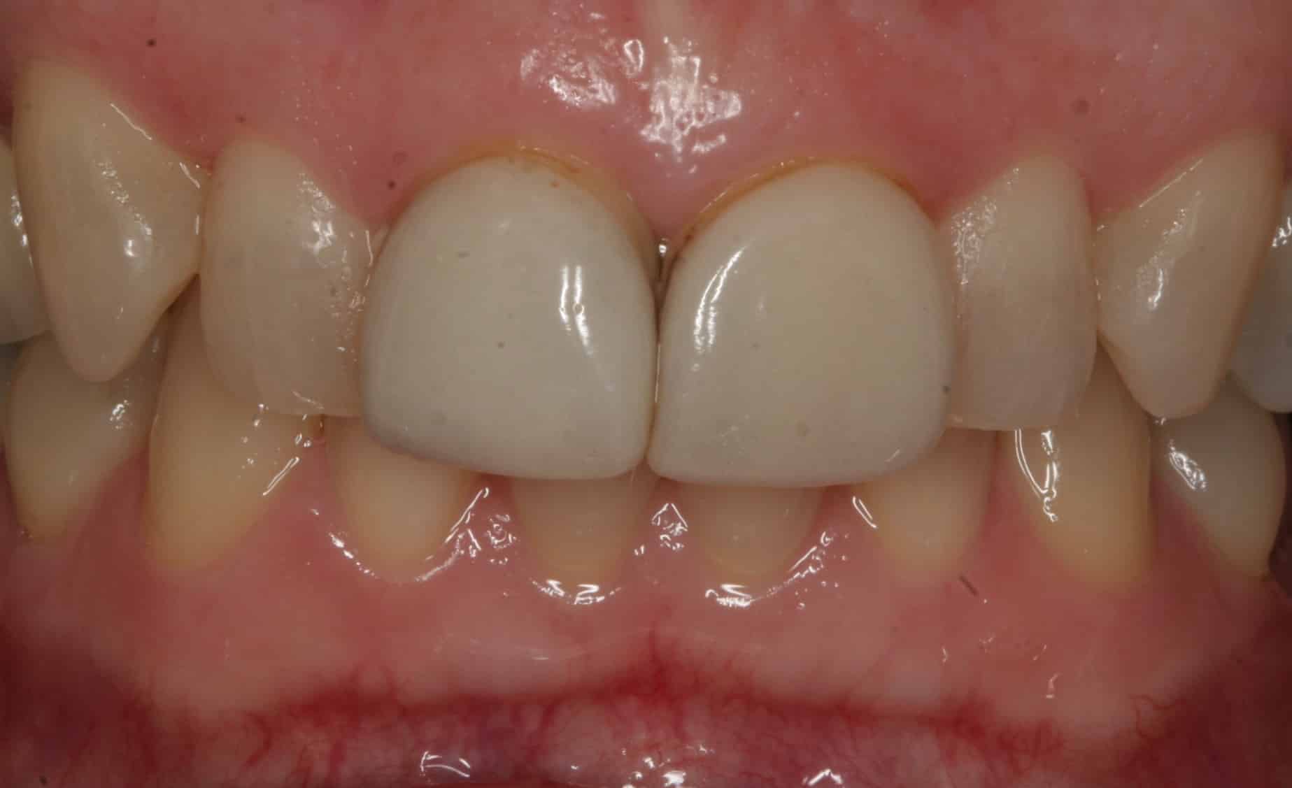 Before Dental Treatment Westover Family Dentistry in Winchester, VA