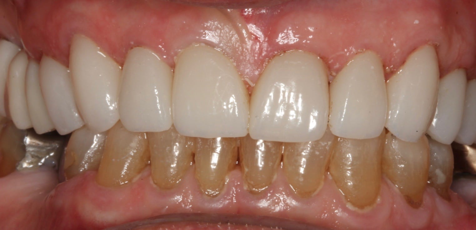 After Dental Treatment Westover Family Dentistry in Winchester, VA