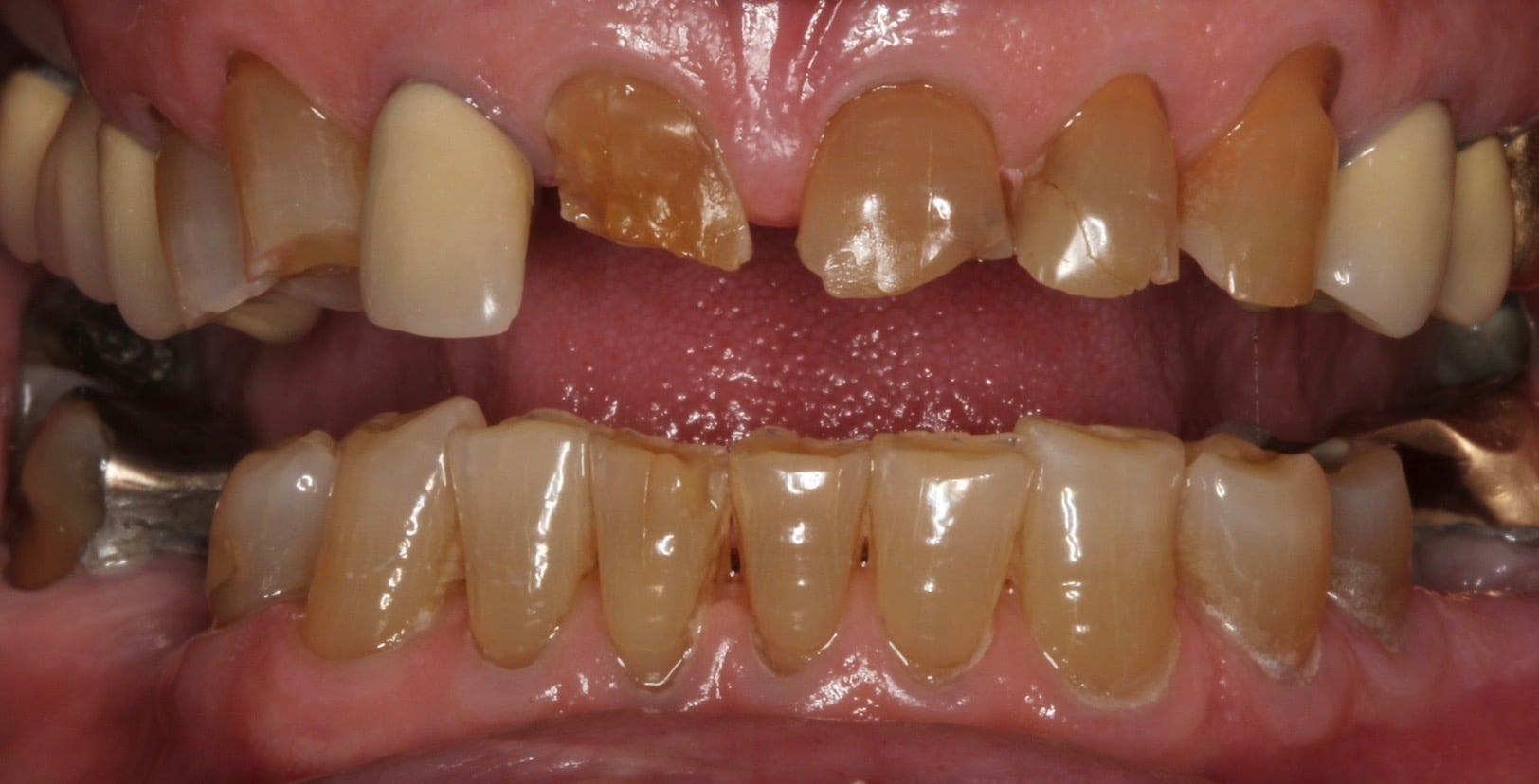 Before Dental Treatment Westover Family Dentistry in Winchester, VA