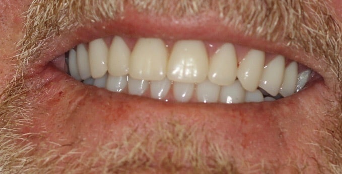 After Dental Treatment Westover Family Dentistry in Winchester, VA