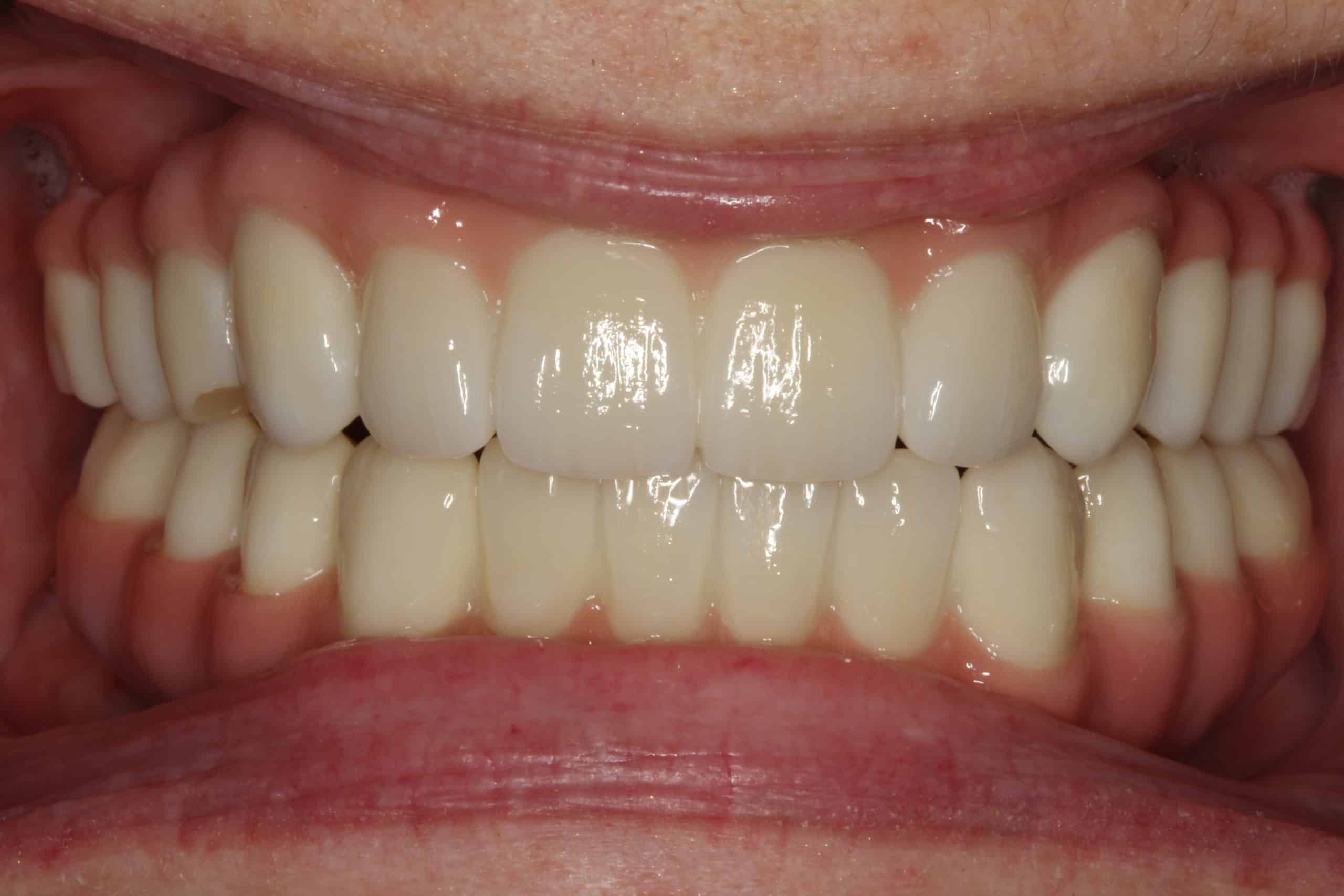 After Dental Treatment Westover Family Dentistry in Winchester, VA