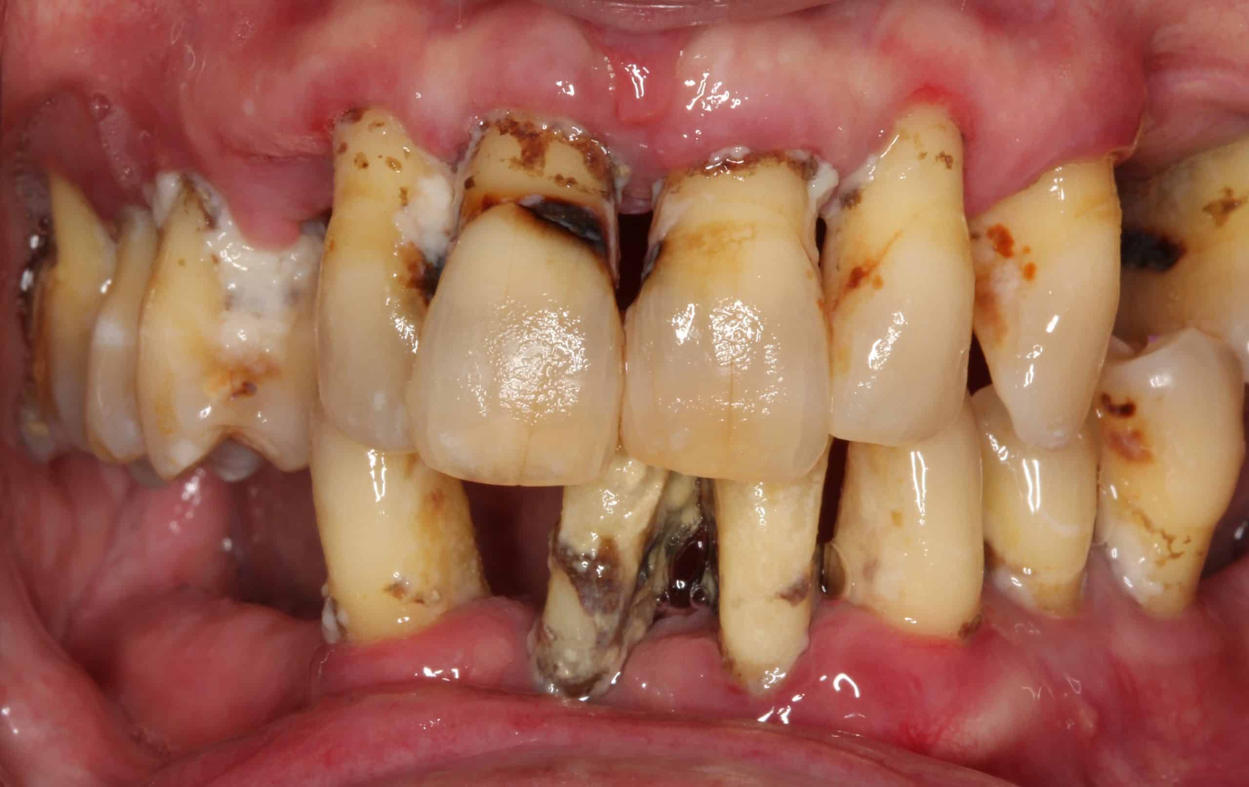 Before Dental Treatment Westover Family Dentistry in Winchester, VA