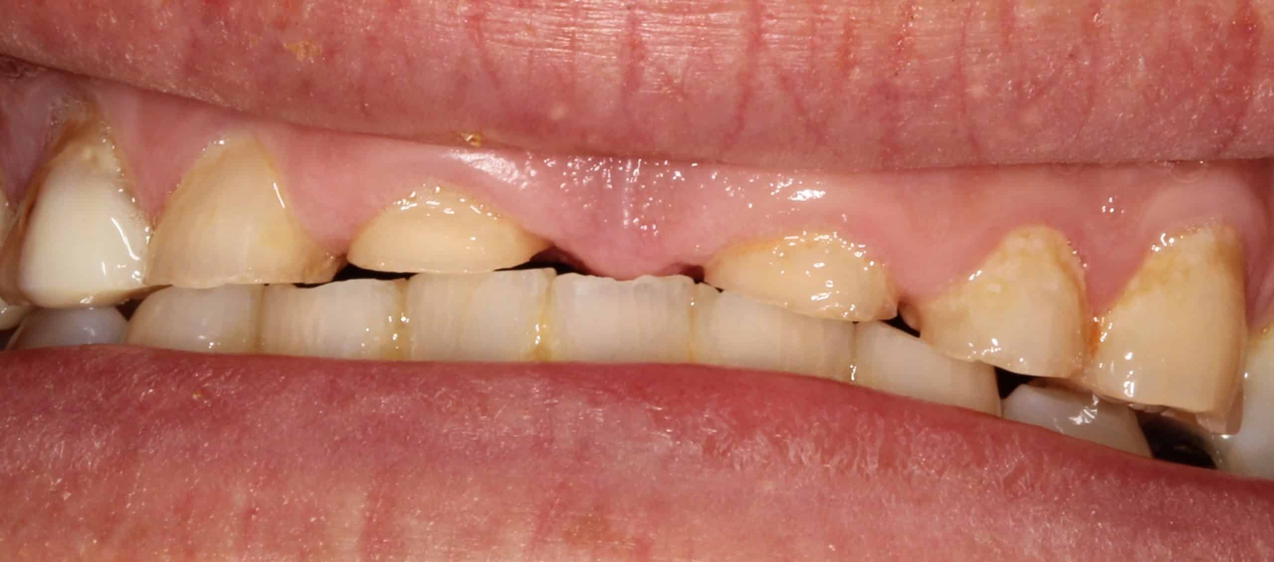 Before Dental Treatment Westover Family Dentistry in Winchester, VA