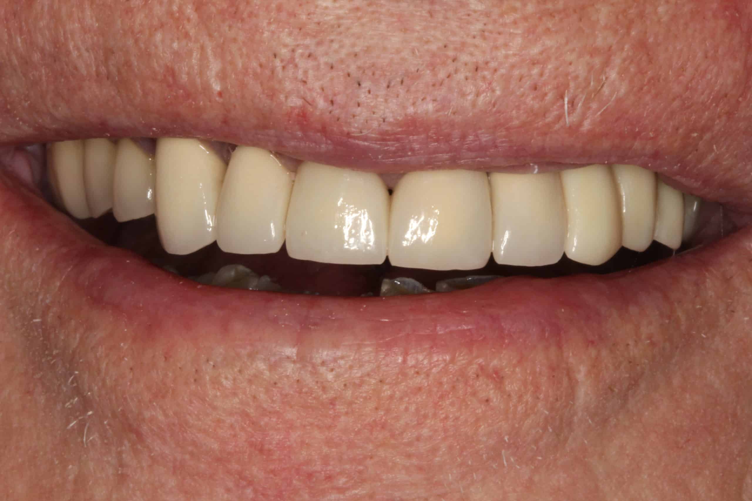 After Dental Treatment Westover Family Dentistry in Winchester, VA