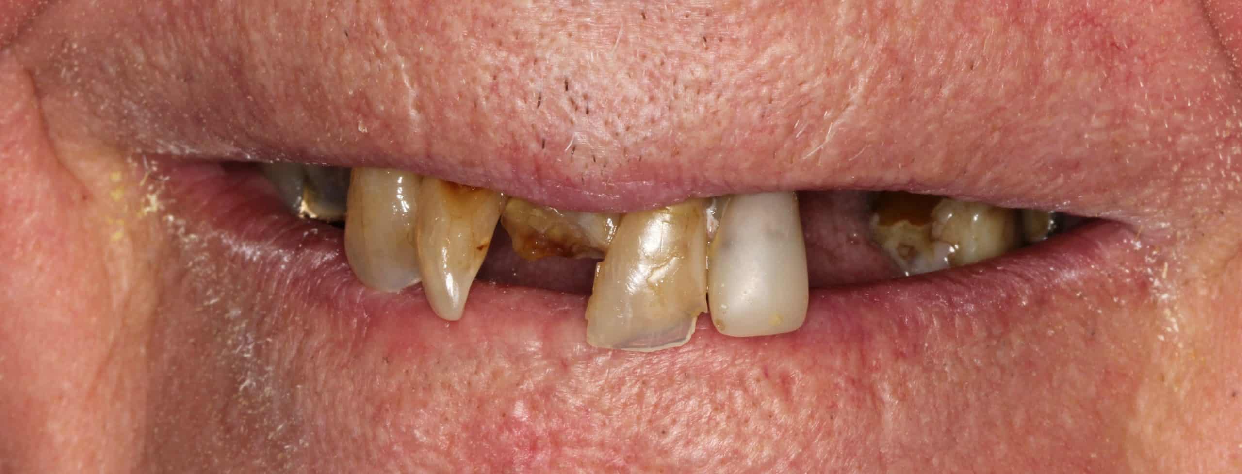 Before Dental Treatment Westover Family Dentistry in Winchester, VA