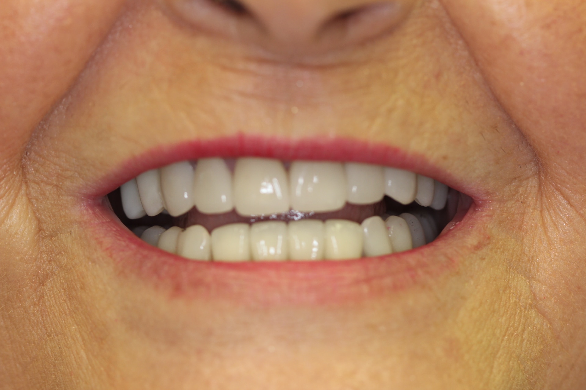 After Dental Treatment Westover Family Dentistry in Winchester, VA