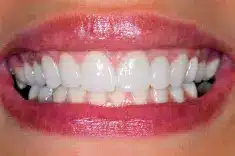 Veneers Westover Family Dentistry in Winchester, VA